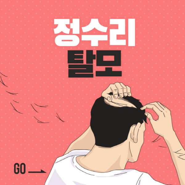 정수리-탈모-치료-여자-비용-초기-모발이식-남자